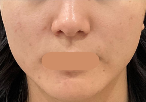 4回施術 4か月後