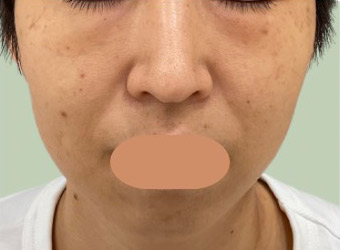 3回施術 3か月後