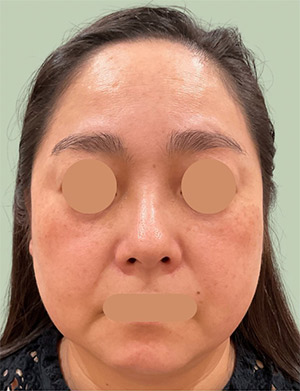 マッサージピールによる治療前