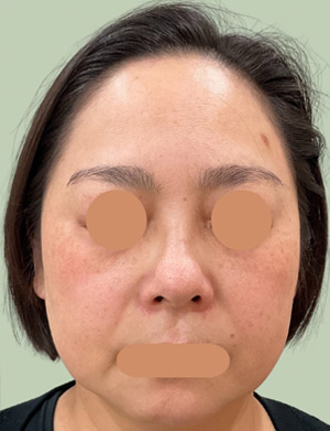 マッサージピールによる3回施術 6か月後