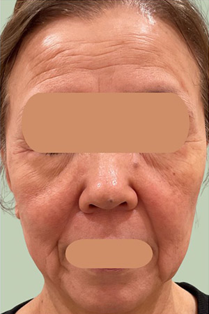 フォトフェイシャルStellar M22による治療前