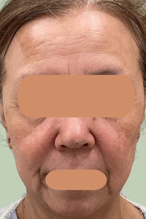 フォトフェイシャルStellar M22 3回施術 4か月後