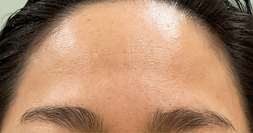 5か月後 3回施術