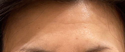 5か月後 4回施術