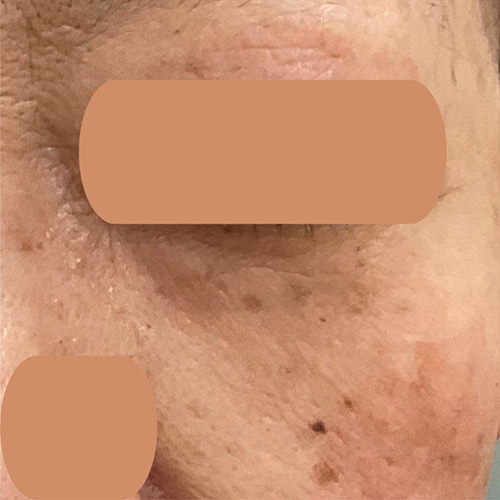 2回セット治療後半年経過