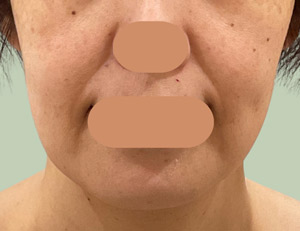 1回施術 3週間後