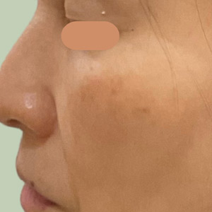 2回施術 4週間後