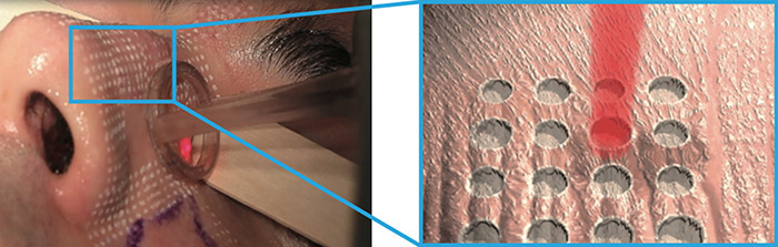 CO2レーザー/フラクショナルレーザー