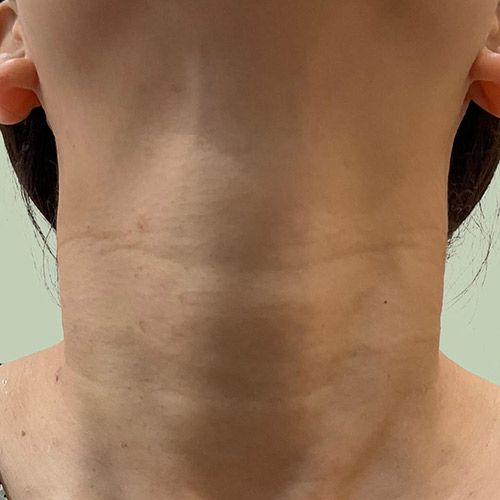 CO2レーザー（AcuPulse™）による治療10日後