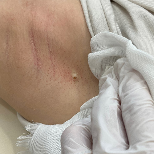 CO2レーザー（AcuPulse™）による治療直後