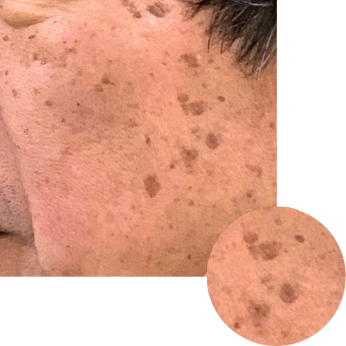 CO2レーザー（AcuPulse™）による治療前