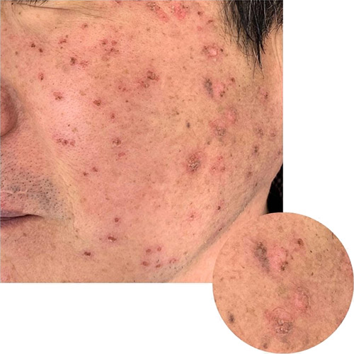 CO2レーザー（AcuPulse™）による治療直後