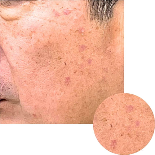 CO2レーザー（AcuPulse™）による治療2週間後