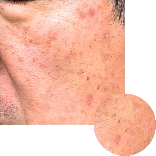 CO2レーザー（AcuPulse™）による治療3週間後