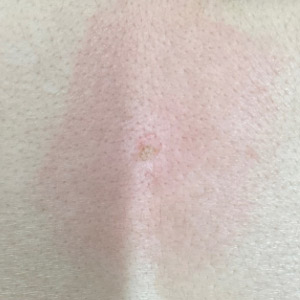 CO2レーザー（AcuPulse™）による治療直後