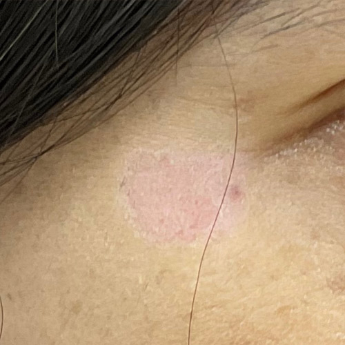 CO2レーザー（AcuPulse™）による治療6日後