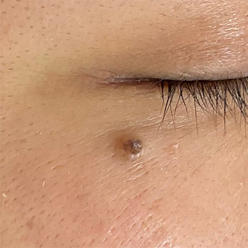 CO2レーザー（AcuPulse™）による治療前