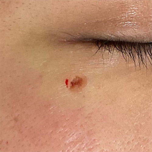 CO2レーザー（AcuPulse™）による治療直後