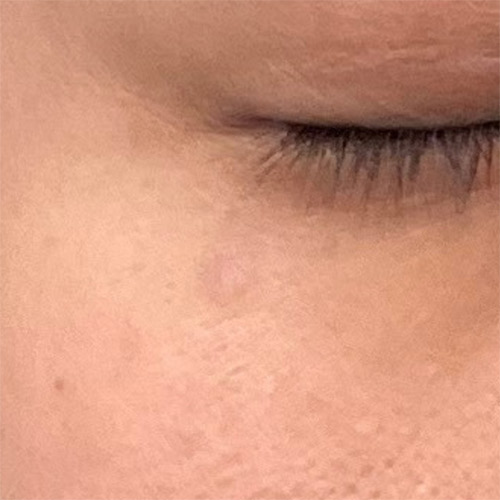 CO2レーザー（AcuPulse™）による治療3か月後